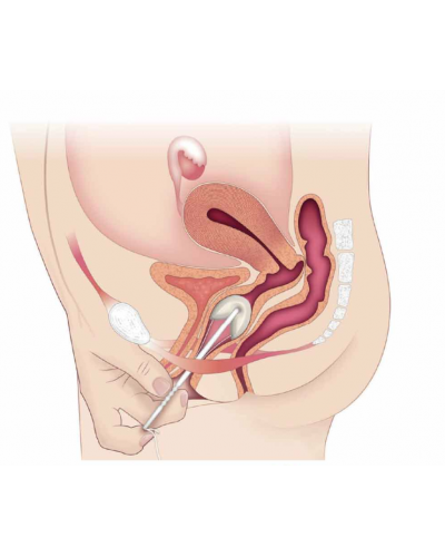Contrelle Activgard - Paragüas incontinencia urinaria soporte vegija